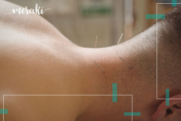 acupuntura